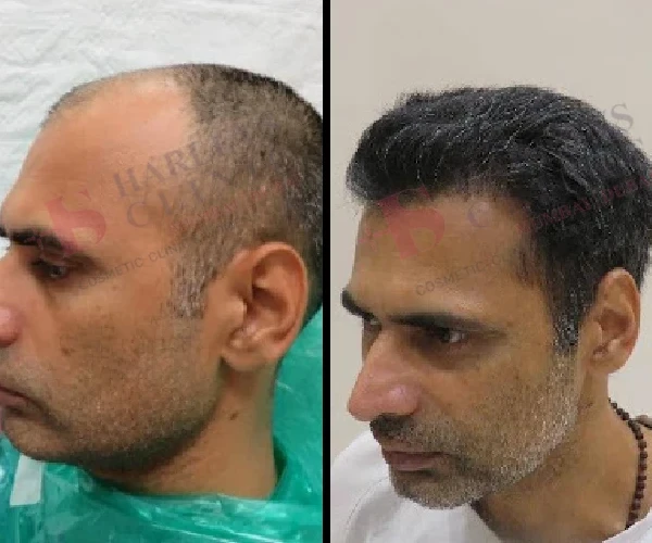 Hair Transplant Before and After 2