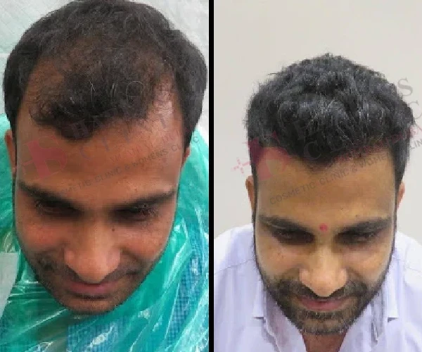 Hair Transplant Before and After 3