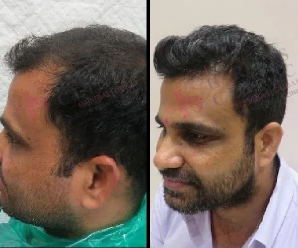 Hair Transplant Before and After 4